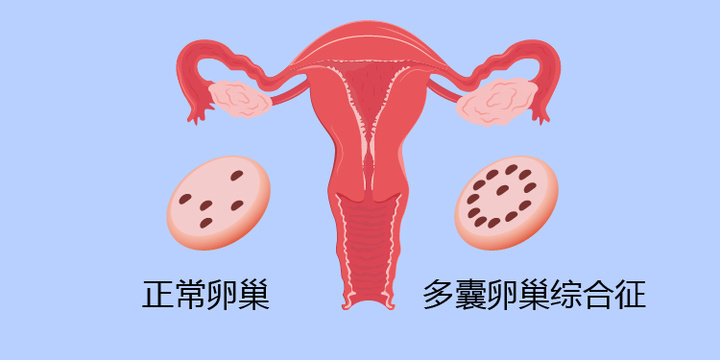 人工授精和借卵做试管婴儿的区别是什么，如何做出选择？