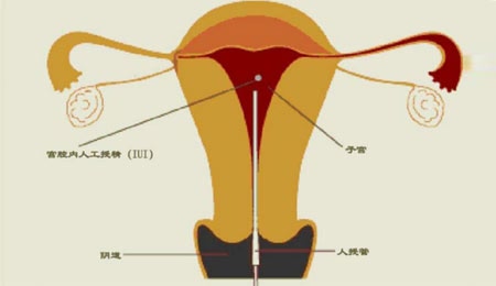 取别人的卵做借卵试管婴儿可以吗